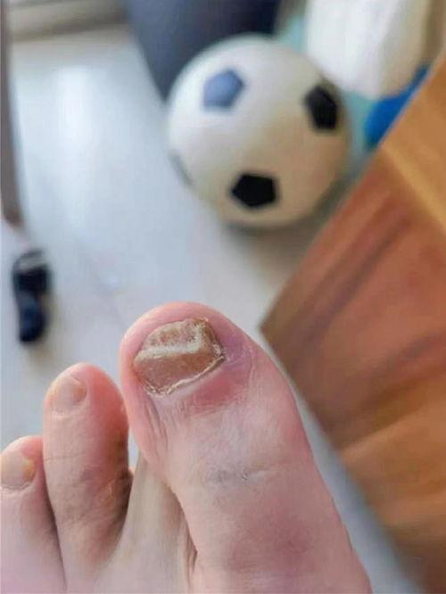 明星都没有灰指甲么